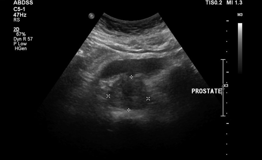 Prostatite de ultrasóns antes de tomar zxcvbnmqwert