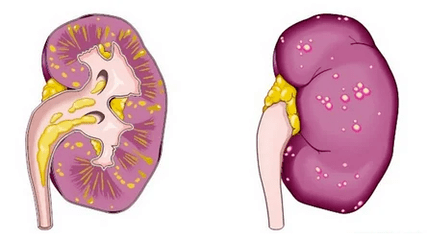 A que leva a prostatite aguda