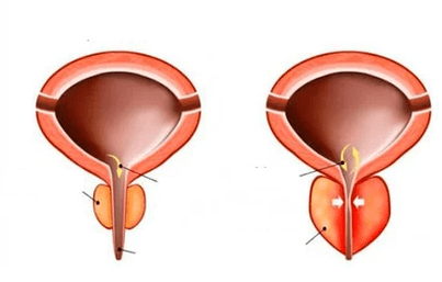 Que é a prostatite aguda