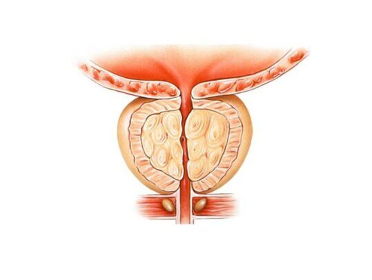 Aumento da próstata con prostatite